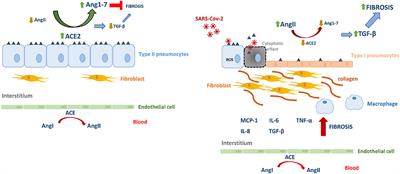 SARS-CoV-2 Pathogenesis: Imbalance in the Renin-Angiotensin System Favors Lung Fibrosis